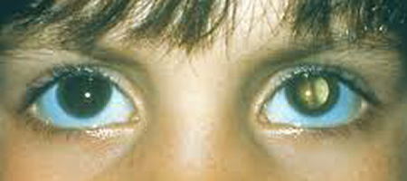 Congenital Eye Disease - Eyes Alive