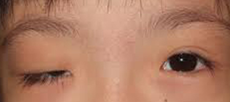 Congenital Eye Disease - Eyes Alive